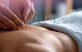 acupuncture treatment session showing practitioner placing needles on patient for pain relief stress reduction and holistic health support