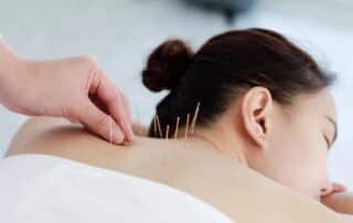 acupuncture therapy session in greenwich connecticut with practitioner applying needles to patient for pain relief and holistic wellness treatment